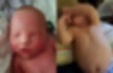 Bak Ular, Kulit Bayi Ini Menebal dan Berganti Setiap Minggu, Ternyata Ini Penyebabnya