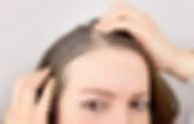 Kurang Vitamin Bikin Rambut Remaja Beruban? Ini 3 Penyebab Lainnya!