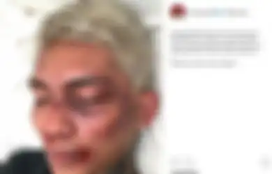 Young Lex Unggah Foto Babak Belur Dihajar K-Popers Garis Keras, Ternyata Semua Hanya HOAX