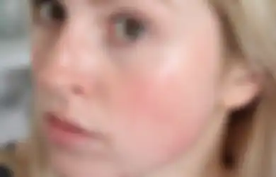 3 Skincare Kekinian Ini Ampuh Redakan Kemerahan di Wajah, Dijamin Bak Bintang Iklan Cerah Mulus Seketika