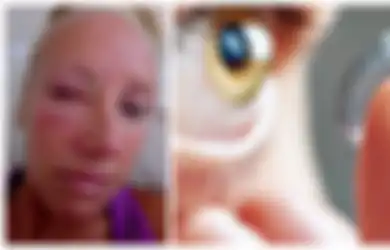 Tragis, Pakai Contact Lens Saat Mandi,  Wanita Ini Kehilangan Penglihatannya