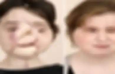 Inilah Transformasi Wajah Katie Stubblefield, si Penerima Transplantasi Wajah dari 7 Orang Lainnya