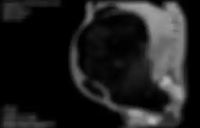 Jangan Sepelekan Sembelit, Pria Ini Didiagnosis Derita 'Megarectum' karena Sering Sembelit