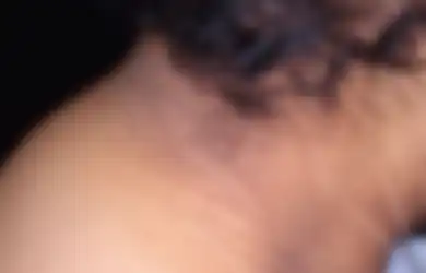 Jika Kulit Leher Belakang Menebal dan Terlihat Hitam, Hati-hati Bisa Jadi Tanda Adanya Penyakit Ini