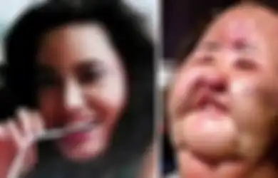 5 Operasi Plastik yang Berakhir Gagal Paling Mengerikan di Dunia, Wajah-wajah Cantik Mereka Sebelum Operasi Bikin Miris