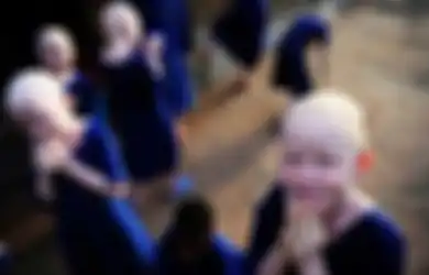 Kehidupan Tragis Orang Albino di Afrika, Jadi Buruan karena Bagian Tubuhnya Dianggap 'Bertuah'