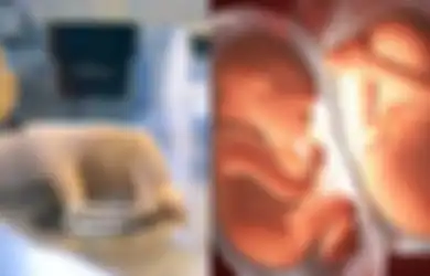41 Tahun yang Lalu, Bayi Tabung Pertama di Dunia Lahir, Begini Sejarahnya