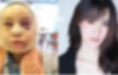 Wajah Wanita Ini 'Bengkak' Selama 3 Bulan Setelah Operasi Plastik, Tapi Lihat Hasilnya