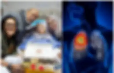Istri Indro Warkop Meninggal Karena Kanker Paru-paru, Ini 9 Gejala Kanker Paru-paru yang Sering Tak Disadari