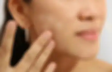 Seperti Panu, Kenali Penyebab Bercak Putih di Wajah Agar Bisa Segera Diatasi