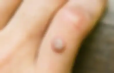 Cara Menghilangkan Kutil di Tangan dan Kaki Secara Alami dengan Cepat