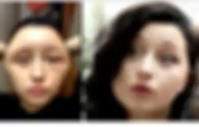 Alergi Pewarna Rambut, Bentuk Kepala Gadis Ini Berubah dan Ia Mengaku Hampir Mati