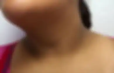 Jangan Anggap Remeh, Kulit Leher Belakang Menebal dan Terlihat Hitam Bisa Jadi Tanda Penyakit Berbahaya Ini!