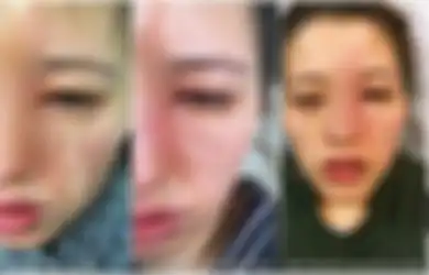 Gunakan Minyak Esensial, Wanita Ini Kaget Saat Pagi Hari Bercermin dan Melihat Wajahnya Terbakar!