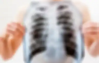 Batuk, Demam, hingga Pusing, Ini 7 Gejala Pneumonia, Jangan Dianggap Remeh Ya!