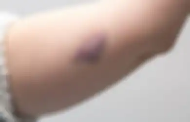 Ini 5 Gejala Leukemia yang Sering Kali Diabaikan, Salah Satunya Memar di Tubuh