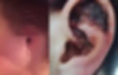 Disangka Kutil Selama 5 Tahun, Wanita Ini Harus Rela Telinganya Diamputasi, Ternyata Ini Penyebab Sebenarnya