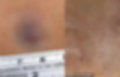 Miliki Luka Memar Selama 6 Tahun, Wanita Baru Sadar Jika Itu Adalah Penyakit Mematikan