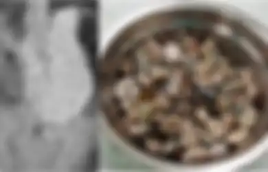 Seorang Pria Mengeluh Sakit Perut, Dokter Terkejut Temukan 2 Kg Batu, Koin, dan Tutup Botol dalam Perut Pria Tersebut