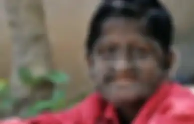 Kisah Bocah Langka di India yang Tubuhnya Dipenuhi Rambut Mirip Bak Serigala, Apa Penyebabnya?