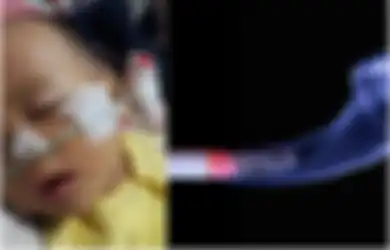 Kisah Seorang Bayi yang Derita Penyakit Ini Gegara Ayahnya Perokok, Begini Cara Efektif Agar Bisa Berhenti Merokok
