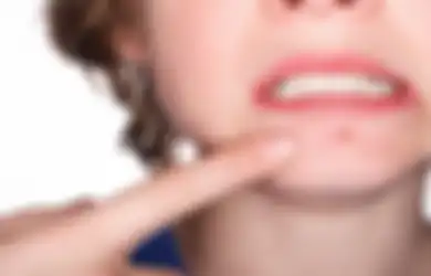 Jerawat Nggak Sembuh-sembuh padahal Sudah Lakukan Perawatan Wajah? Bisa Jadi Sejumlah Makanan Ini Belum Kamu Hindari!