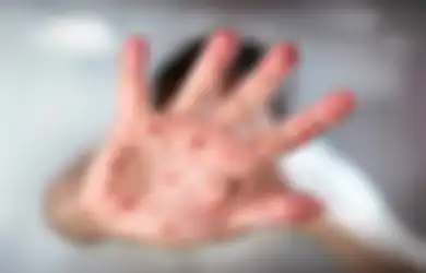 Waspadai Demam Tinggi  dan Sakit Kepala Berat! Inilah Gejala Cacar Monyet dari Hari ke Hari Menurut Kemenkes, Meski Bisa Sembuh Sendiri dan Belum Mewabah di Indonesia
