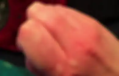 Ini 2 Obat Biduran Alami Jika Anda Alami Gatal-gatal Karena Alergi