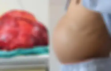 Alami Kondisi Kesehatan Tak Lazim, Perut Pria Ini Terus Membesar Bak Wanita Hamil, Dokter Syok Temukan Benda Ini Saat Lakukan Pembedahan