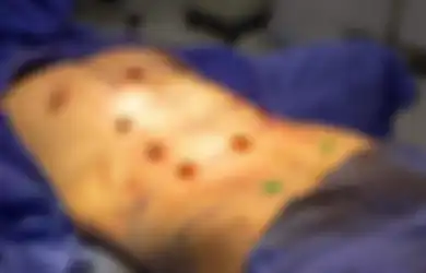 Tak Mau Berolahraga, Kini Sudah Ada Operasi Six Pack Instan, Biayanya Rp53 Juta!