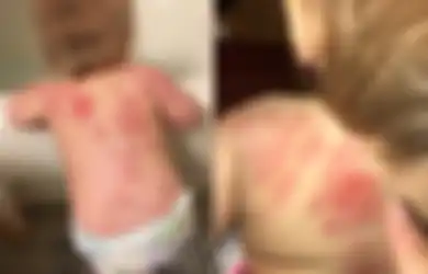 Ditemukan Lebih dari 25 Bekas Gigitan di Punggung Bayi Ini Setelah Ibunya Mengambilnya dari Tempat Penitipan Anak