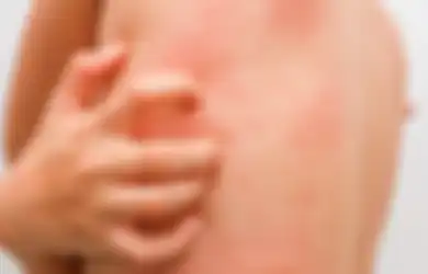 Biduran Karena Alergi? Ini 3 Obat Biduran Alami yang Bisa Anda Gunakan
