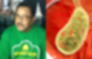 Rano Karno Pernah Lakukan Pengangkatan Empedu, Kebiasaan yang Sering Disepelekan ini Bisa Jadi Penyebabnya