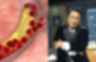 Hotman Paris Hutapea Pernah Didiagnosa Penyempitan Pembuluh Darah: Ini Gejala, Faktor Risiko dan Pencegahannya
