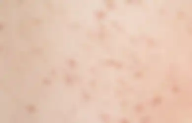 Nyesel Baru Tahu Sekarang, Langkah Sederhana Ini Mampu Usir Jerawat di Badan
