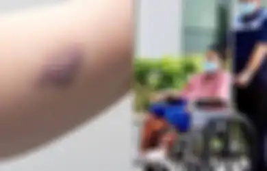 Ani Yudhoyono Meninggal Dunia, Inilah 16 Gejala Leukemia yang sering Dianggap Remeh Orang