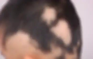 Menyisir Rambut Anak dan Temukan Kebotakan? Kenali Kelainan Alopesia Areata