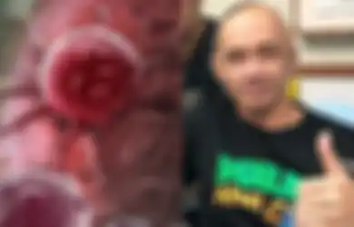 Ini 12 Makanan Super untuk Melawan Kanker, Termasuk Kanker Otak yang Diderita Agung Hercules, Salah Satunya Ubi Jalar