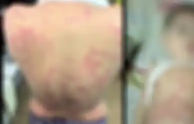 Bayi Ini Tertular Alergi Kulit Lewat ASI Karena Produk Pemutih Palsu yang Dipakai Ibunya, Peringatan Bagi Orangtua!