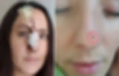 Dikira Hanya Jerawat Biasa, Wanita ini Justru Terkena Kanker Kulit Karena Sering Berjemur