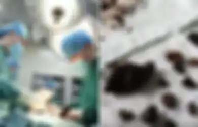 Ngeri! Akibat Sering Lewatkan Sarapan Selama 10 Tahun, Dokter Keluarkan 200 Batu Empedu Sebesar Telur dari Dalam Perut Wanita ini
