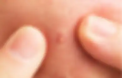 Jerawat Makin Parah, 5 Kandungan Skincare Ini Harus Dihindari Saat Jerawatan!