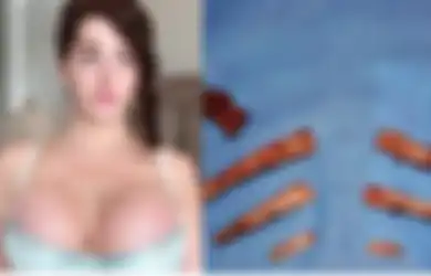 Diejek Berdada Rata Hingga Malu, Akhirnya Wanita Ini Nekat Jalani Operasi Payudara dan Pinggul dengan Implan, Apa yang Kemudian Terjadi?