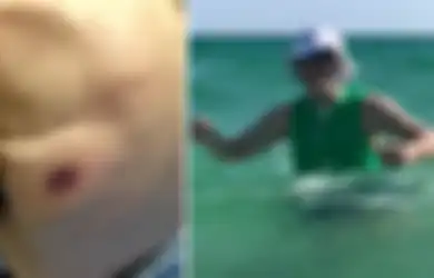 Kurang dari 48 Jam Setelah Berenang di Pantai, Pria Ini Terinfeksi Bakteri Pemakan Daging dan Meninggal