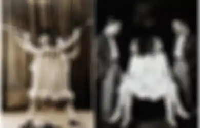Kisah Tragis Kembar Siam Daisy dan Violet Hilton, Diperbudak Walinya hingga Berakhir Seperti Ini