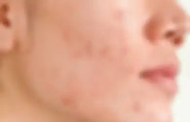 Enggak Jadi Mulus, 5 Kebiasaan Skincare Ini Bikin Kulit Makin Rusak!