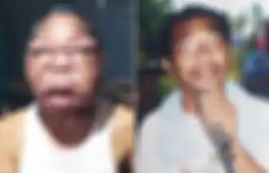 Wajahnya Membengkak Jadi 'Raksasa', Pria Ini Alami Penyakit Mistrius, Begini Gejalanya