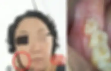 Wanita Meninggal 5 Hari Usai Cabut Gigi Bungsu, Keluarganya Tak Terima Dokter Sebut Penyebab Kematiannya Karena Tumor