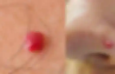 Punya Benjolan Mirip Tahi Lalat Berwarna Merah Seperti Ini? Jangan Khawatir, Ini Artinya