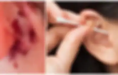 Mengerikan, Gara-gara Sering Pakai Cotton Bud, Wanita Ini Alami Infeksi Otak hingga Gerogoti Tengkorak Belakang Telinga